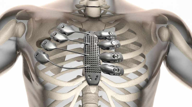 Cancer patient receives 3D printed titanium sternum and ribs in world-first surgery