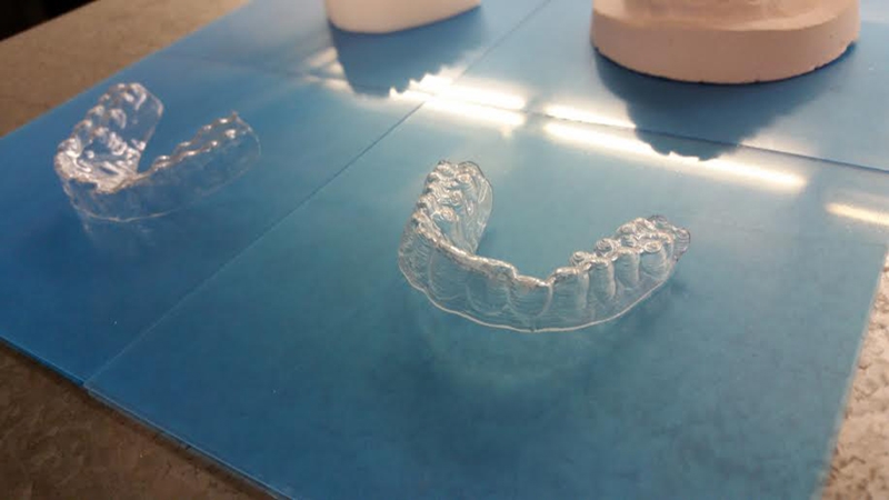 How one broke college student 3D printed his own braces to correct misaligned teeth