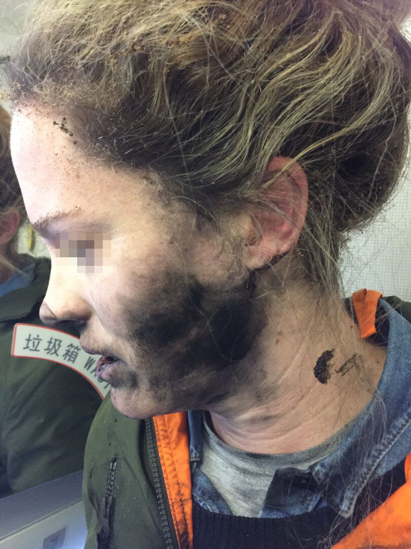 Exploding headphone battery burns woman during flight