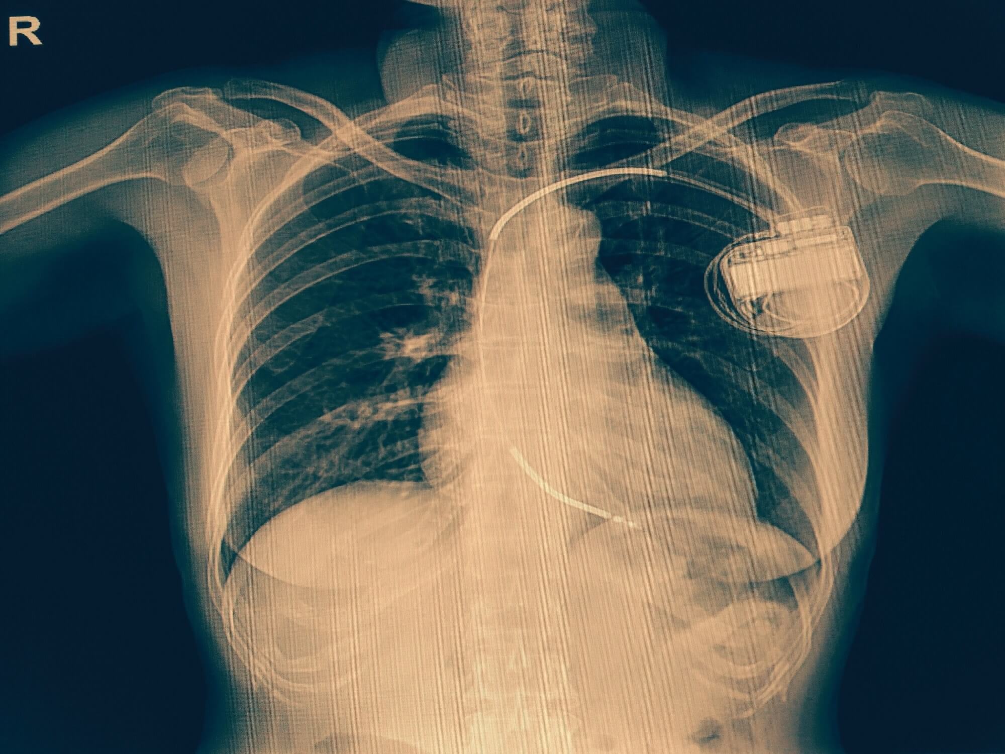 Vulnerability in thousands of Medtronic implantable defibrillators could let hackers control devices