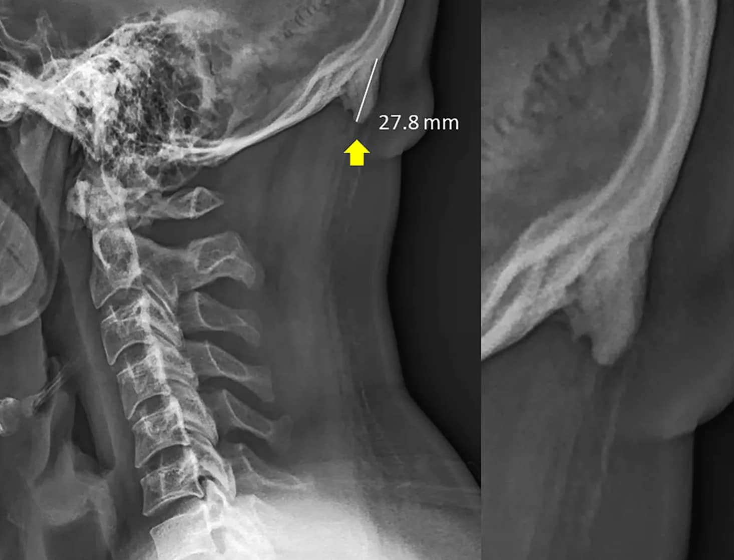 Research suggests young people are growing horns in skulls due to excessive phone usage