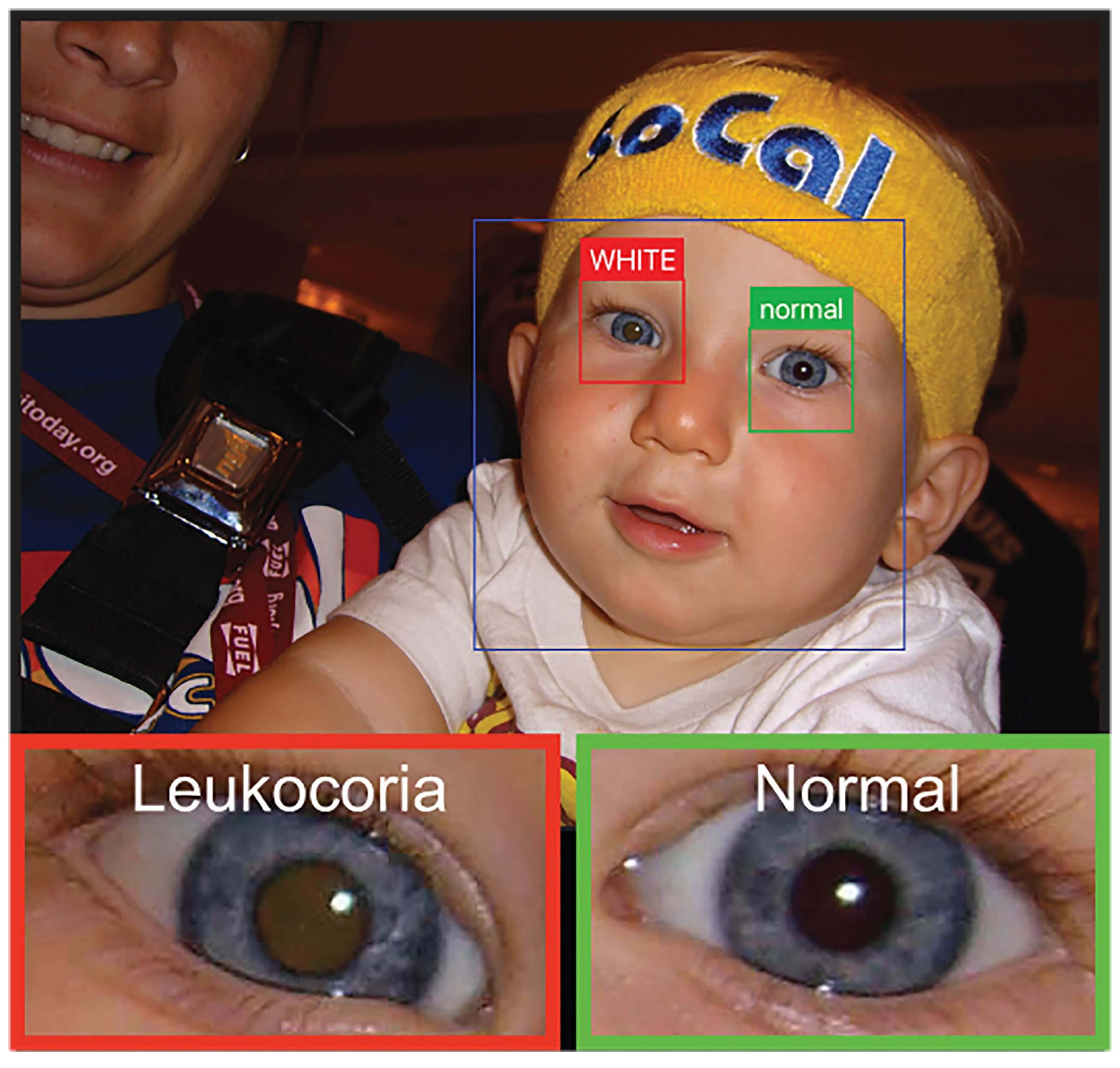 Researchers develop mobile app to spot eye diseases in personal photos