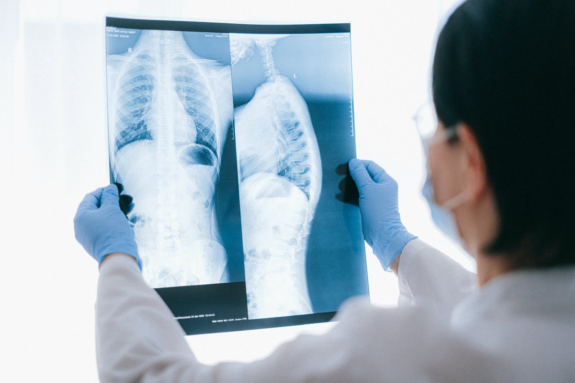 AI is just as good as a doctor at analyzing chest X-rays