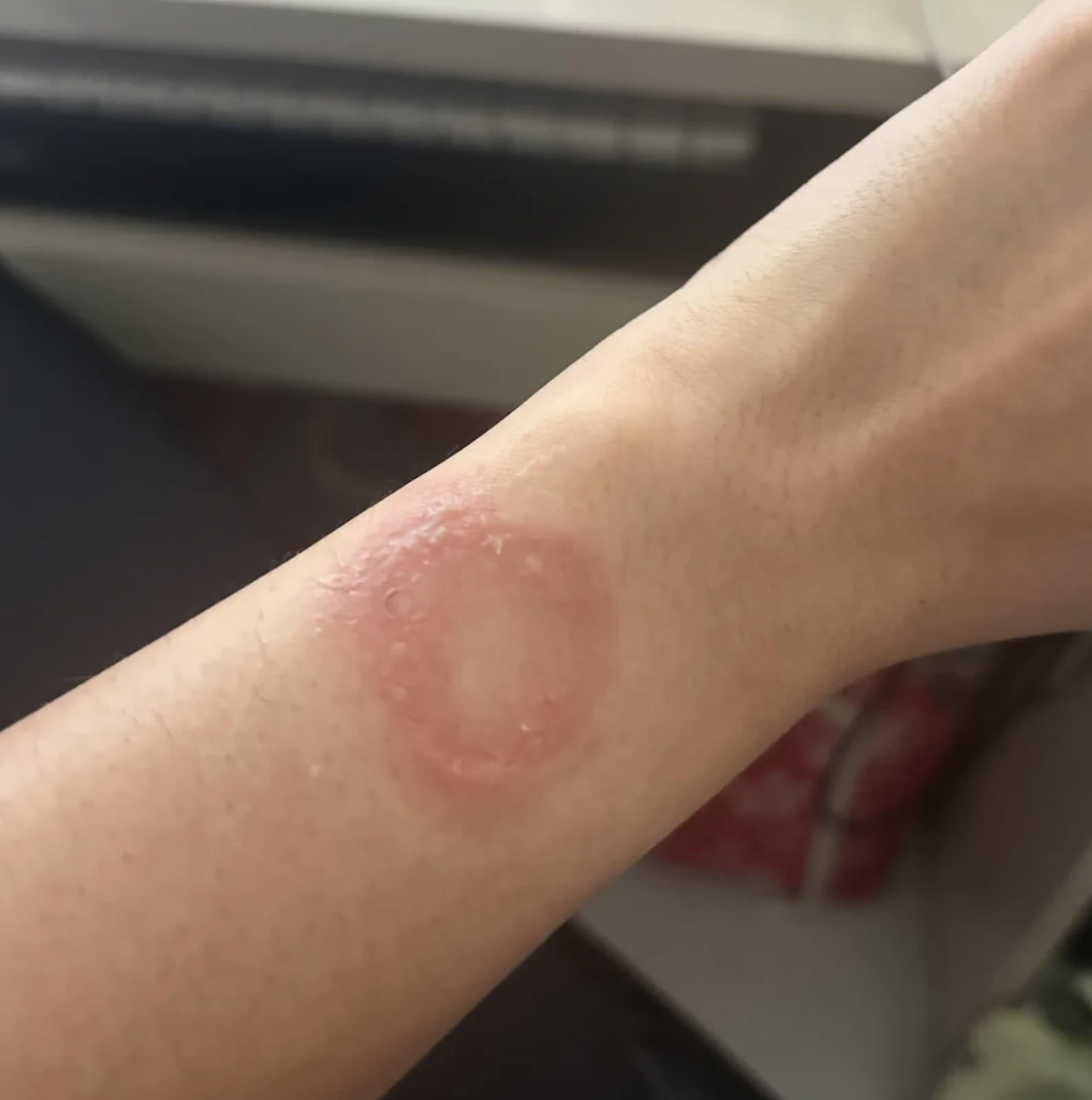User says Apple Watch caused severe wrist burns, case still unresolved six months later