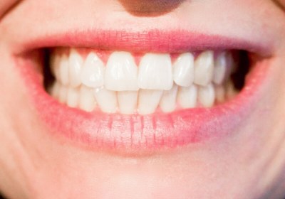 drug alzheimer teeth dentine fillings tideglusib