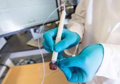 revolutionary surgery cancer