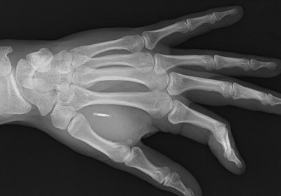 chip implant microchip xray