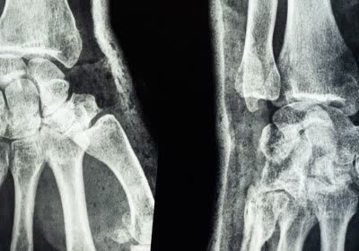french bataclan x-ray nft france medical
