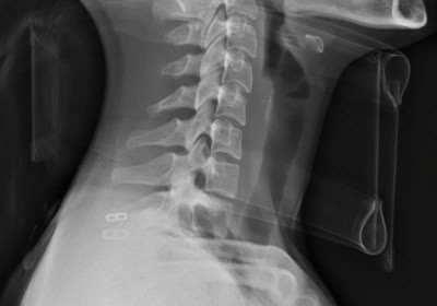 pluripotent japan research healthcare spinal injury stem cells keio university