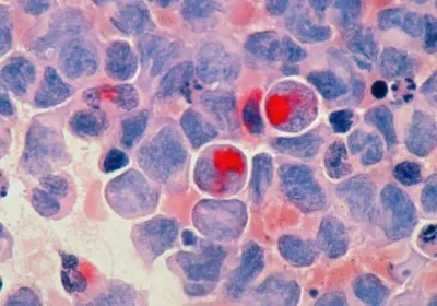 google yale research cancer healthcare deepmind