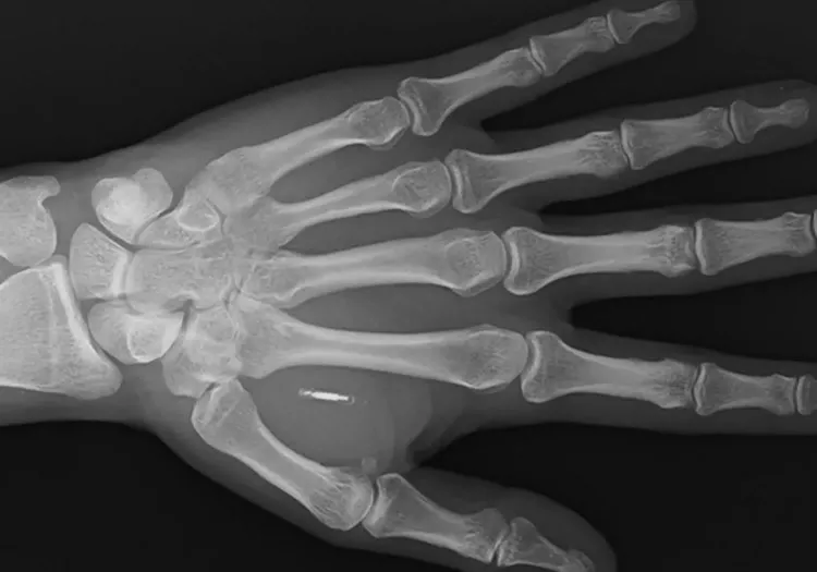 nfc rfid implant microchipping