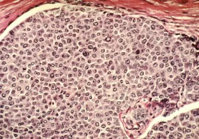 cancer ultrasound healthcare histosonics with video